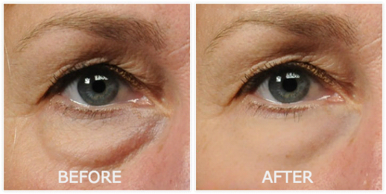 Before and after under-eye appearance illustration for Revitol Eye Cream